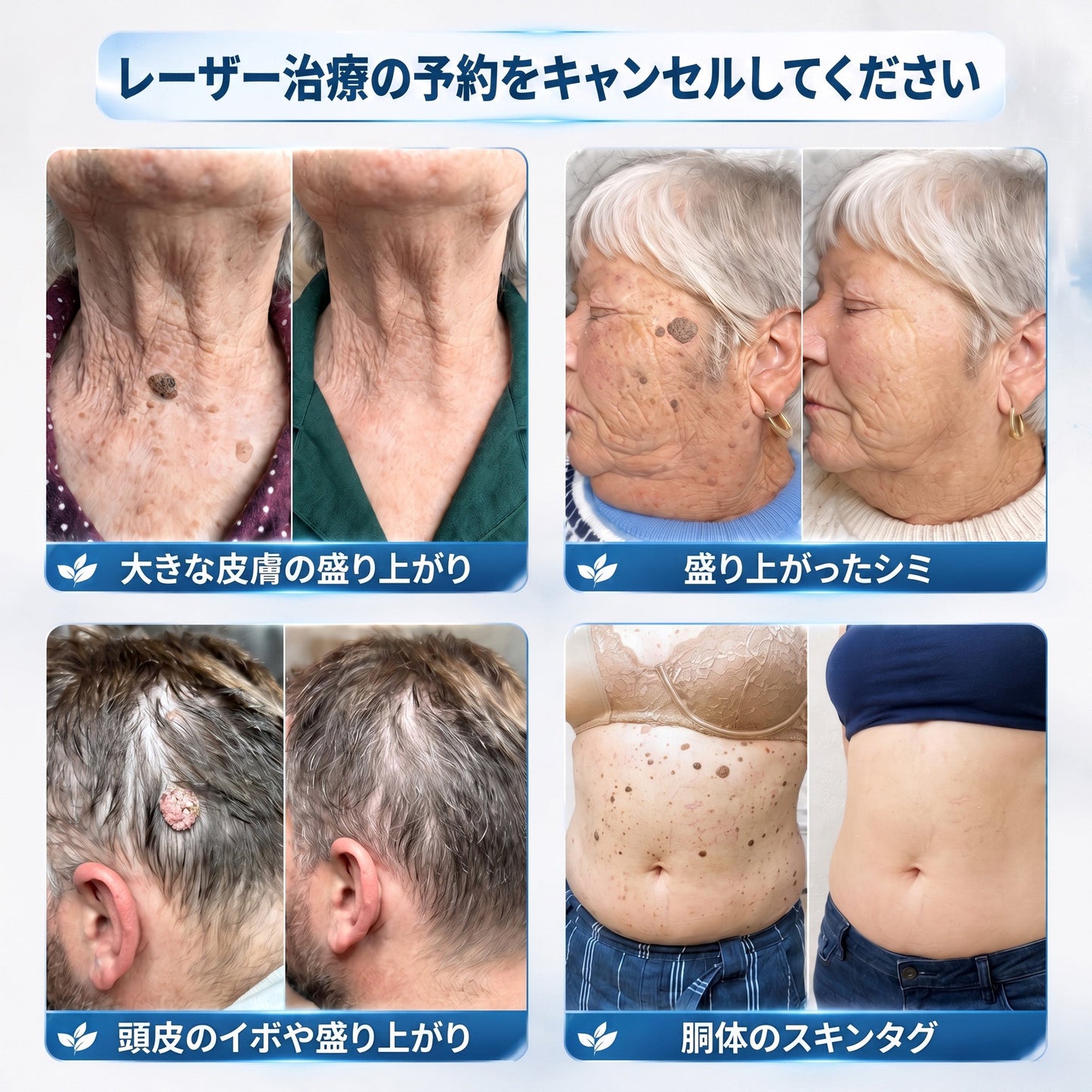 𝐇𝐈𝐒𝐊𝐈𝐍®👩‍⚕️ 7日間 スキンタグ＆スポットイレーサー｜痛みがなく、傷跡を残さない 高機能スポット除去ローラーボールペン