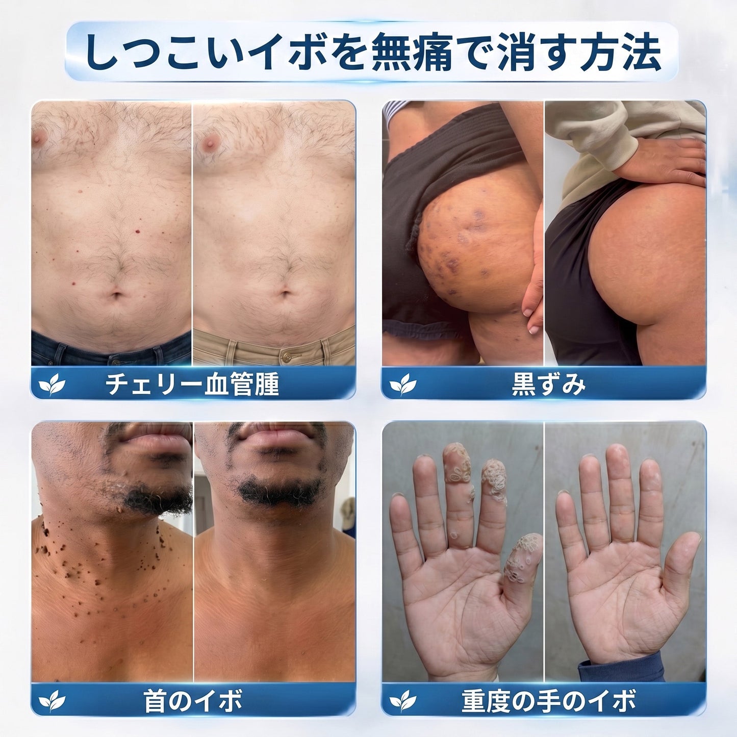 𝐇𝐈𝐒𝐊𝐈𝐍®👩‍⚕️ 7日間 スキンタグ＆スポットイレーサー｜痛みがなく、傷跡を残さない 高機能スポット除去ローラーボールペン