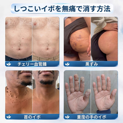 𝐇𝐈𝐒𝐊𝐈𝐍®👩‍⚕️ 7日間 スキンタグ＆スポットイレーサー｜痛みがなく、傷跡を残さない 高機能スポット除去ローラーボールペン