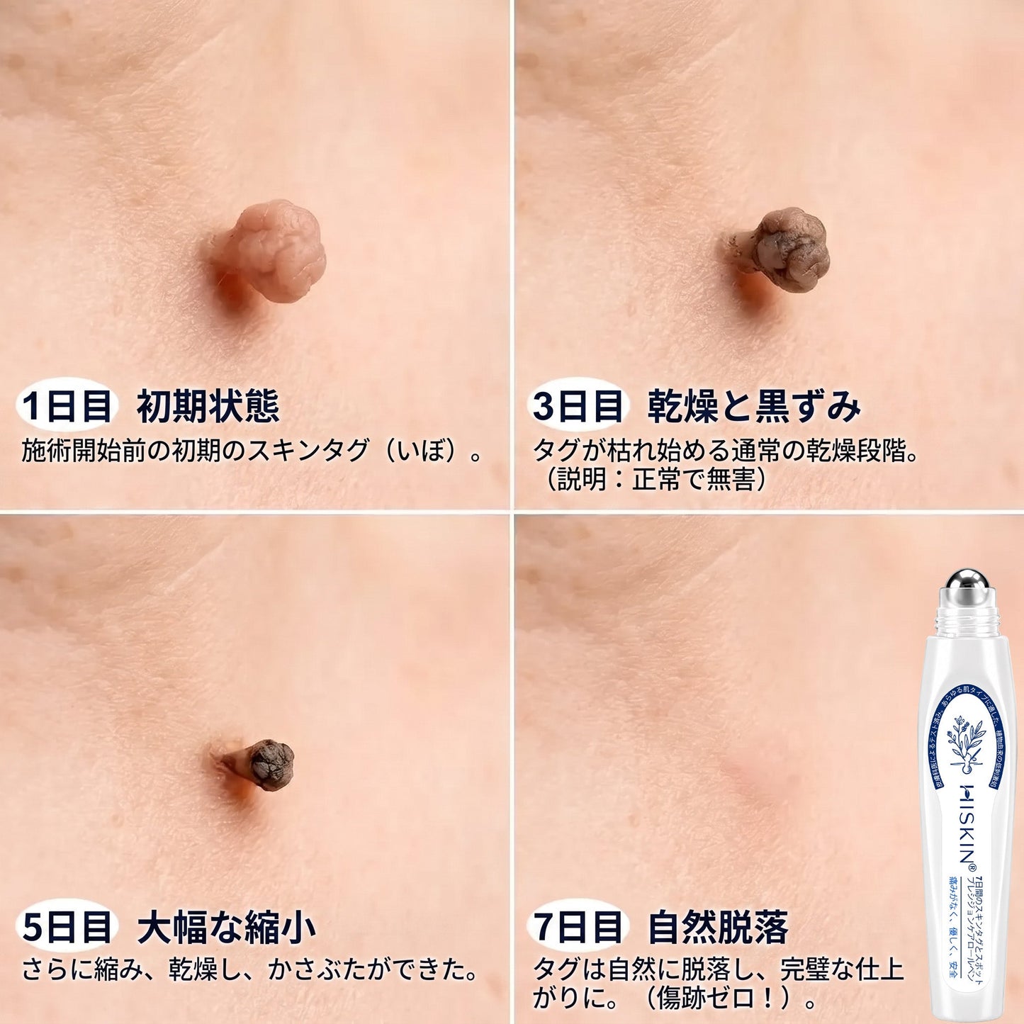 𝐇𝐈𝐒𝐊𝐈𝐍®👩‍⚕️ 7日間 スキンタグ＆スポットイレーサー｜痛みがなく、傷跡を残さない 高機能スポット除去ローラーボールペン